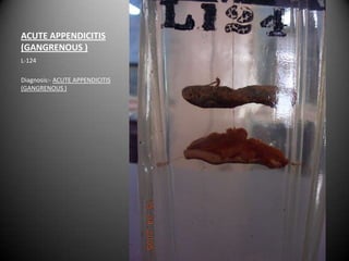 ACUTE APPENDICITIS
(GANGRENOUS )
L-124

Diagnosis:- ACUTE APPENDICITIS
(GANGRENOUS )
 
