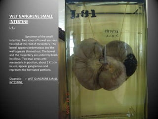 WET GANGRENE SMALL
INTESTINE
L-31

             Specimen of the small
intestine. Two loops of bowel are seen
twisted at the root of mesentery. The
bowel appears oedematous and the
wall appears thinned out. The bowel
and the mesentery are uniformly black
in colour. Two oval areas anti-
mesenteric in position, about 2 X 1 cm
in size, appear gangrenous and
represent the herniated portions.

Diagnosis :- WET GANGRENE SMALL
INTESTINE.
 