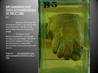 DRY GANGRENE FOOT
(WITH AUTOAMPUTATION
OF THE 5TH TOE)
B-5

              Specimen of the right foot
showing loss of the 5th toe with an oval
ulcer at the base. The floor of the
ulcer is depressed and covered with
slough.
              The big toe shows
blackish discolouration and appears
shrunken and mummified. The line of
demarcation between healthy and
devitalized tissue is sharp. Early
discolouration of the second toe is also
present.

Diagnosis :- DRY GANGRENE FOOT
(WITH AUTOAMPUTATION OF THE 5TH
TOE)
 