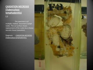 CASEATION NECROSIS
(Tuberculous
lymphadenitis)
F-3

              The specimen is of
multiple, matted, mesenteric lymph
nodes. The cut surface shows
replacement of the nodes by a cheesy
necrotic tissue (caseation).

Diagnosis :-CASEATION NECROSIS
(Tuberculous lymphadenitis).
 