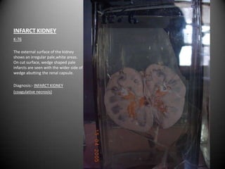 INFARCT KIDNEY
K-76

The external surface of the kidney
shows an irregular pale,white areas.
On cut surface, wedge shaped pale
infarcts are seen with the wider side of
wedge abutting the renal capsule.

Diagnosis:- INFARCT KIDNEY
(coagulative necrosis)
 