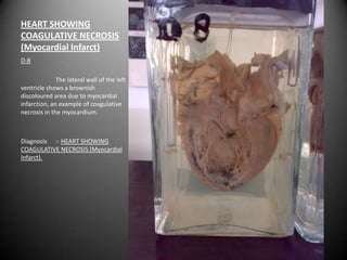 HEART SHOWING
COAGULATIVE NECROSIS
(Myocardial Infarct)
D-8

              The lateral wall of the left
ventricle shows a brownish
discoloured area due to myocardial
infarction, an example of coagulative
necrosis in the myocardium.



Diagnosis :- HEART SHOWING
COAGULATIVE NECROSIS (Myocardial
Infarct).
 