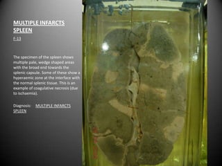 MULTIPLE INFARCTS
SPLEEN
F-13



The specimen of the spleen shows
multiple pale, wedge shaped areas
with the broad end towards the
splenic capsule. Some of these show a
hyperaemic zone at the interface with
the normal splenic tissue. This is an
example of coagulative necrosis (due
to ischaemia).

Diagnosis:   MULTIPLE INFARCTS
SPLEEN
 