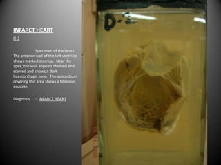 INFARCT HEART
D-2

             Specimen of the heart.
The anterior wall of the left ventricle
shows marked scarring. Near the
apex, the wall appears thinned and
scarred and shows a dark
haemorrhagic zone. The epicardium
covering this area shows a fibrinous
exudate.

Diagnosis    :- INFARCT HEART
 