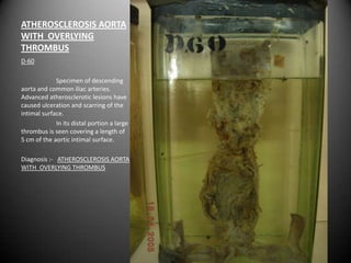 ATHEROSCLEROSIS AORTA
WITH OVERLYING
THROMBUS
D-60

             Specimen of descending
aorta and common iliac arteries.
Advanced atherosclerotic lesions have
caused ulceration and scarring of the
intimal surface.
             In its distal portion a large
thrombus is seen covering a length of
5 cm of the aortic intimal surface.

Diagnosis :- ATHEROSCLEROSIS AORTA
WITH OVERLYING THROMBUS
 
