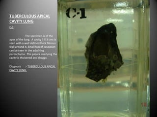 TUBERCULOUS APICAL
CAVITY LUNG
C-1

               The specimen is of the
apex of the lung. A cavity 3 X 3 cms is
seen with a well defined thick fibrous
wall around it. Small foci of caseation
can be seen in the adjoining
parenchyma. The pleura overlying the
cavity is thickened and shaggy.

Diagnosis :- TUBERCULOUS APICAL
CAVITY LUNG.
 