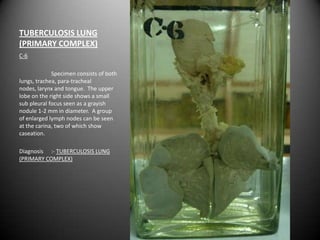 TUBERCULOSIS LUNG
(PRIMARY COMPLEX)
C-6

             Specimen consists of both
lungs, trachea, para-tracheal
nodes, larynx and tongue. The upper
lobe on the right side shows a small
sub pleural focus seen as a grayish
nodule 1-2 mm in diameter. A group
of enlarged lymph nodes can be seen
at the carina, two of which show
caseation.

Diagnosis :- TUBERCULOSIS LUNG
(PRIMARY COMPLEX)
 