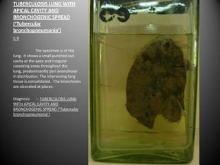 TUBERCULOSIS LUNG WITH
APICAL CAVITY AND
BRONCHOGENIC SPREAD
(‘Tubercular
bronchopneumonia’)
C-9

              The specimen is of the
lung. It shows a small punched out
cavity at the apex and irregular
caseating areas throughout the
lung, predominantly peri-bronchiolar
in distribution. The intervening lung
tissue is consolidated. The bronchioles
are ulcerated at places.

Diagnosis :- TUBERCULOSIS LUNG
WITH APICAL CAVITY AND
BRONCHOGENIC SPREAD (‘Tubercular
bronchopneumonia’)
 