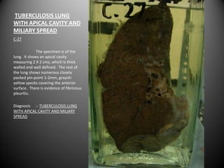 TUBERCULOSIS LUNG
WITH APICAL CAVITY AND
MILIARY SPREAD
C-27

             The specimen is of the
lung. It shows an apical cavity
measuring 2 X 2 cms, which is thick
walled and well defined. The rest of
the lung shows numerous closely
packed pin-point 1-2mm, grayish
yellow specks covering the anterior
surface. There is evidence of fibrinous
pleuritis.

Diagnosis :- TUBERCULOSIS LUNG
WITH APICAL CAVITY AND MILIARY
SPREAD
 
