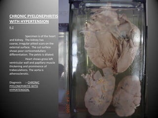 CHRONIC PYELONEPHRITIS
WITH HYPERTENSION
K-2

              Specimen is of the heart
and kidney. The kidney has
coarse, irregular pitted scars on the
external surface. The cut surface
shows poor corticomedullary
differentiation. The pelvis is dilated.
              Heart shows gross left
ventricular wall and papillary muscle
thickening and prominence of
trabeculations. The aorta is
atherosclerotic.

Diagnosis :- CHRONIC
PYELONEPHRITIS WITH
HYPERTENSION.
 