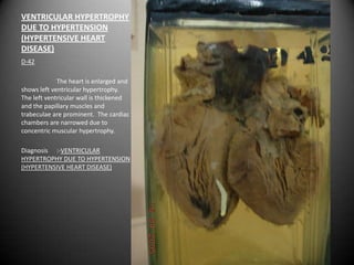 VENTRICULAR HYPERTROPHY
DUE TO HYPERTENSION
(HYPERTENSIVE HEART
DISEASE)
D-42

             The heart is enlarged and
shows left ventricular hypertrophy.
The left ventricular wall is thickened
and the papillary muscles and
trabeculae are prominent. The cardiac
chambers are narrowed due to
concentric muscular hypertrophy.

Diagnosis :-VENTRICULAR
HYPERTROPHY DUE TO HYPERTENSION
(HYPERTENSIVE HEART DISEASE)
 
