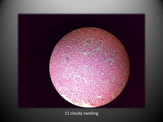 11 cloudy swelling
 