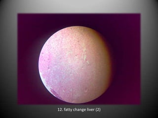 12. fatty change liver (2)
 