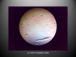 12. FATTY CHANGE LIVER
 