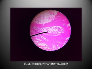 13..MUCOID DEGENERATION STOMACH CA
 