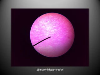 13mucoid degeneration
 