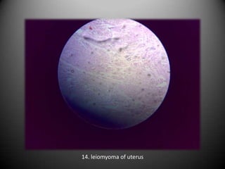 14. leiomyoma of uterus
 
