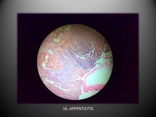 16..APPENTICITIS
 