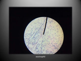 eosinophil
 