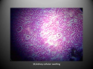 18,kidney cellular swelling
 