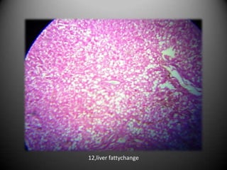 12,liver fattychange
 