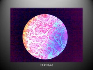19. Cvc lung
 