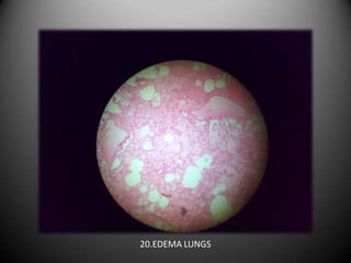 20.EDEMA LUNGS
 