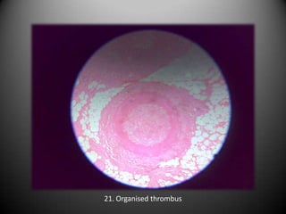 21. Organised thrombus
 
