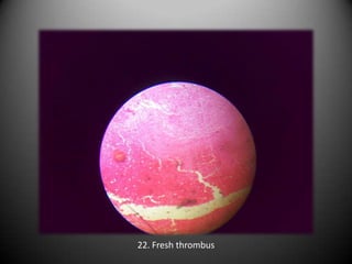 22. Fresh thrombus
 