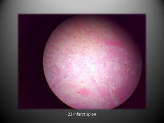 23 infarct splen
 