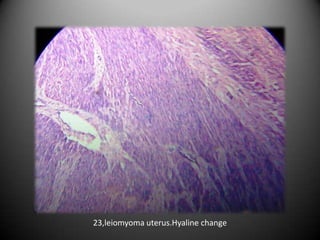 23,leiomyoma uterus.Hyaline change
 