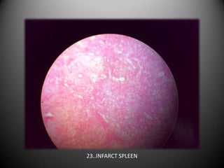 23..INFARCT SPLEEN
 
