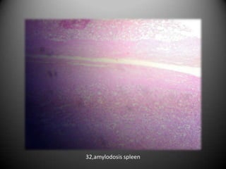 32,amylodosis spleen
 