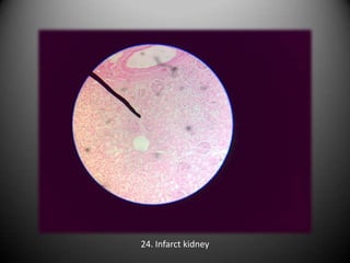 24. Infarct kidney
 