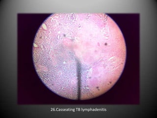 26.Casseating TB lymphadenitis
 