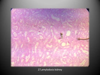 27,amylodosis kidney
 