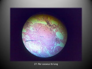 27. fibr casseus tb lung
 