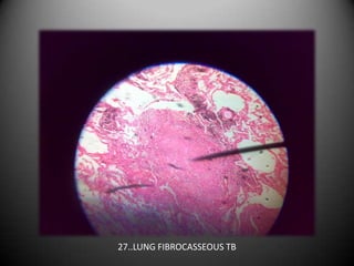 27..LUNG FIBROCASSEOUS TB
 