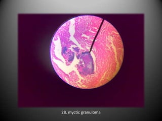 28. myctic granuloma
 