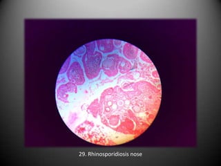 29. Rhinosporidiosis nose
 