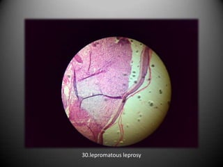 30.lepromatous leprosy
 