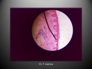 31. T. Leprosy
 