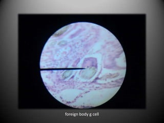 foreign body g cell
 