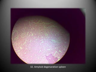 32. Amyloid degenaration spleen
 