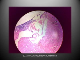 32..AMYLOID DEGENERATION SPLEEN
 