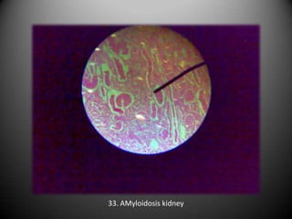 33. AMyloidosis kidney
 