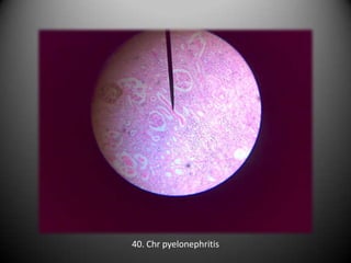40. Chr pyelonephritis
 