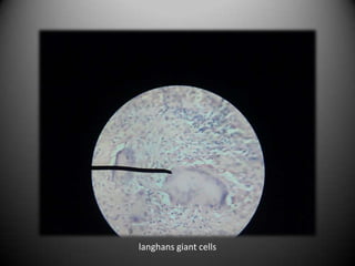 langhans giant cells
 