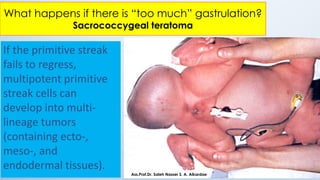 If the primitive streak
fails to regress,
multipotent primitive
streak cells can
develop into multi-
lineage tumors
(containing ecto-,
meso-, and
endodermal tissues).
What happens if there is “too much” gastrulation?
Sacrococcygeal teratoma
Ass.Prof.Dr. Saleh Nasser S. A. Alkardae
 