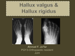 Ahmad F. Ja’far
PGY3-Orthopaedic resident
JUH
 